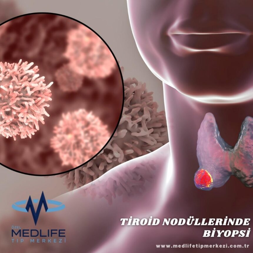 Thyroid Biopsy